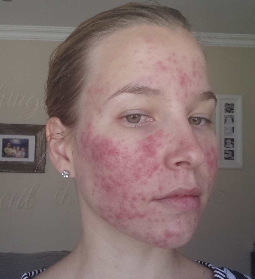 acne skin roaccutane